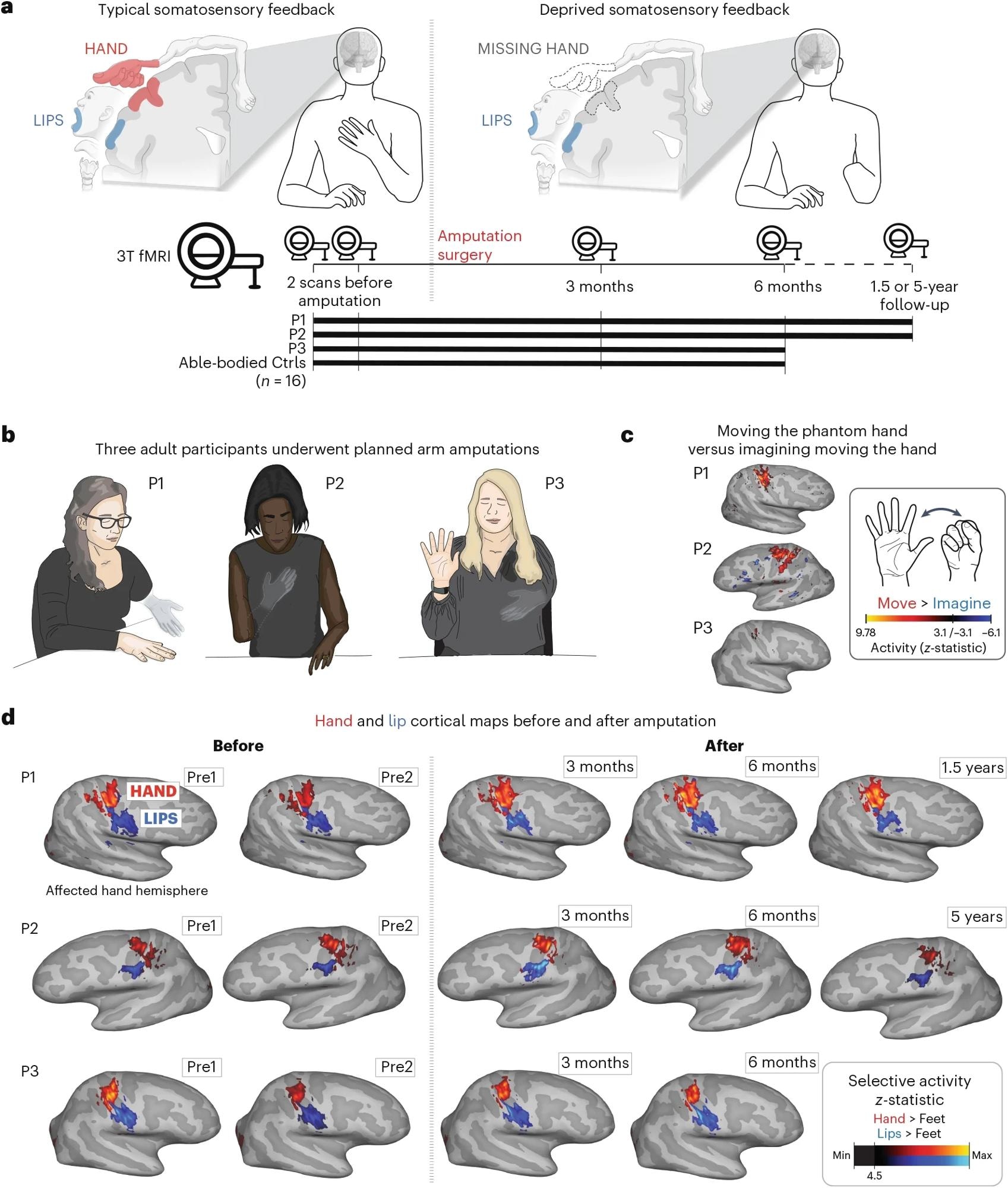 a, Experimental timeline. Scans before and after amputation were conducted across 4–5 time points: twice before, and at 3 months, 6 months and 1.5 (P1)/5 years (P2) after amputation. b, Illustration depicting the three participants 6 months after amputation, including their subjective description of their phantom limb position. c, Phantom movements are not imaginary. Univariate activity (z-scored) contrast map displaying a participant’s attempts to open and close the phantom hand versus imagining movement, 6 months after amputation. d, Participant’s hand (red) and lip (blue) cortical activation maps (contrasted against feet movements) in the affected hand hemisphere across 4–5 sessions. All maps were minimally thresholded at 33% the maximum z-statistic and used a common color scale (the participant’s maximum z-statistic > 4.5). Participants agreed to have their image reproduced. Brain illustrations in a were created in BioRender.