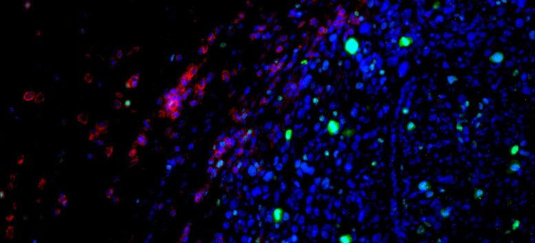 Immune Cells Accumulating and Dividing Within Tumor