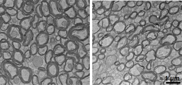 Lithium Deficiency Thins Myelin Sheaths