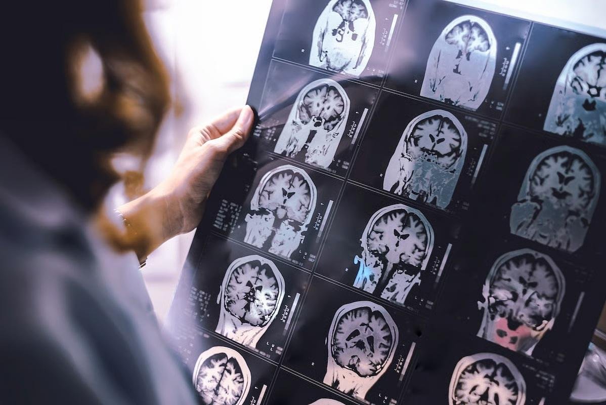 Multiple sclerosis could affect health years before classic symptoms