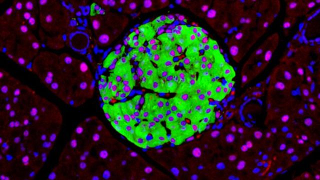 HNF1A Mutation Disrupts Insulin Secretion in Diabetes
