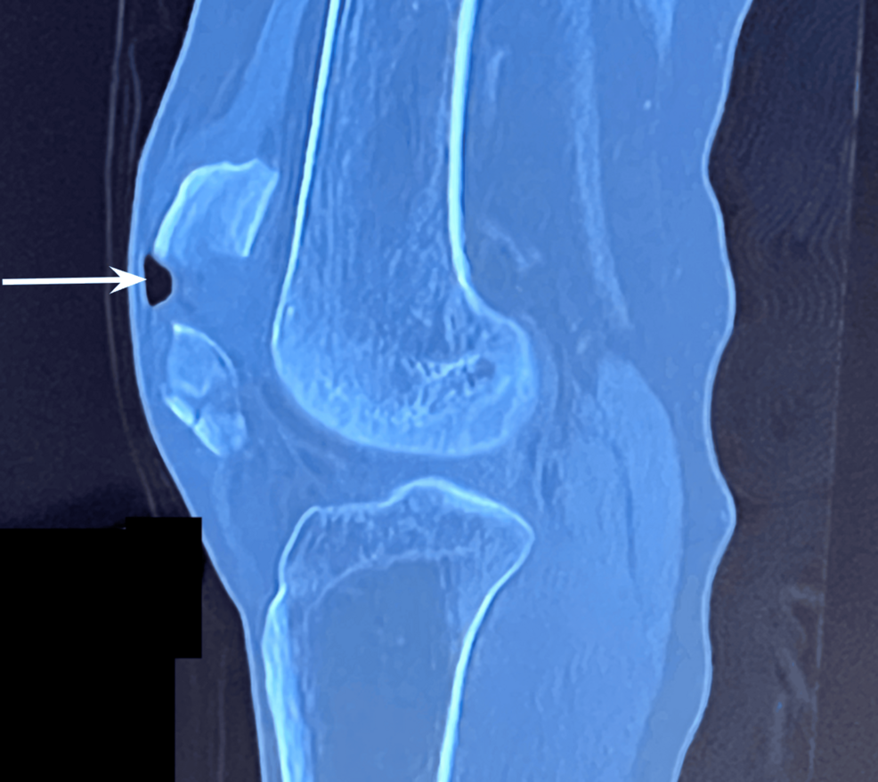 Postoperative Open Reduction Internal Fixation Discomfort and Rehabilitation Response: A Case Report