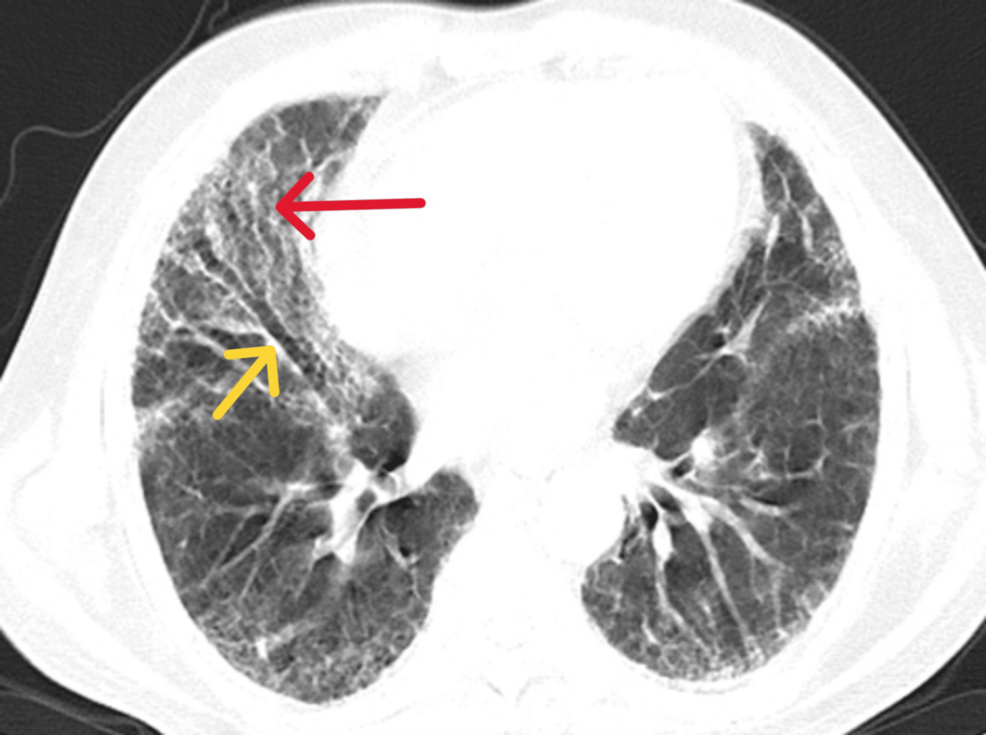 Isolated Rapidly Progressive Interstitial Lung Disease Without Muscle or Skin Involvement in Idiopathic Inflammatory Myopathy: An Unusual Anti-Mi-2 Antibody Phenotype