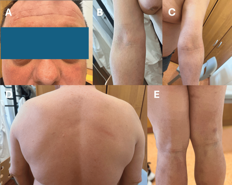 Cardiovascular Comorbidities in Atopic Dermatitis: A Case Report on the Impact of Dupilumab on Skin and Heart Function