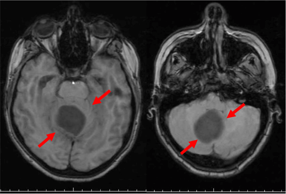 Pancreatic Involvement by Mixed Serous Neuroendocrine Neoplasm Detected by Endosonography With Fine-Needle Tissue Acquisition in Von Hippel-Lindau Disease