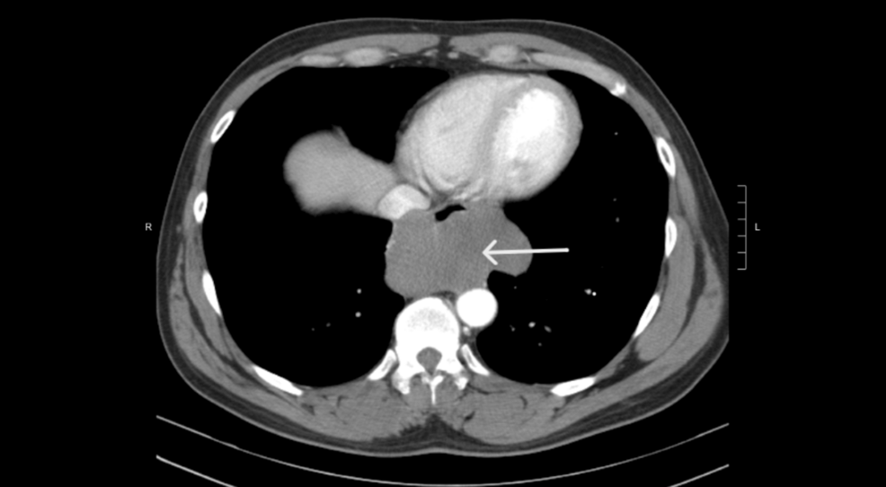A Rare Case of Giant Esophageal Leiomyoma in an Adult Male Presenting With Right Upper Quadrant Pain and Mild Dysphagia