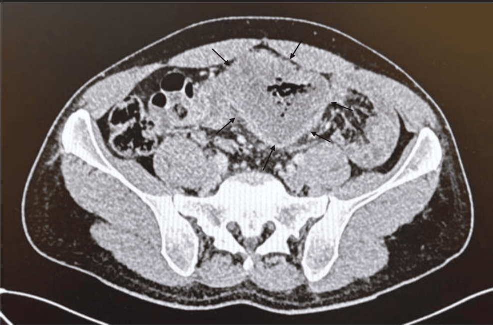 Emergency Colectomy for Obstruction in Microsatellite Instability Colonic Cancer: A Complete Response Following Neoadjuvant Immunotherapy