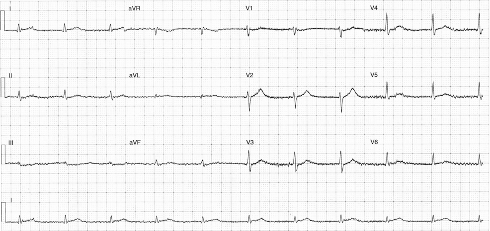 Multisystem Immune-Related Adverse Events Following Pembrolizumab: A Critical Care Case of Myocarditis, Diabetic Ketoacidosis, and CNS Demyelination