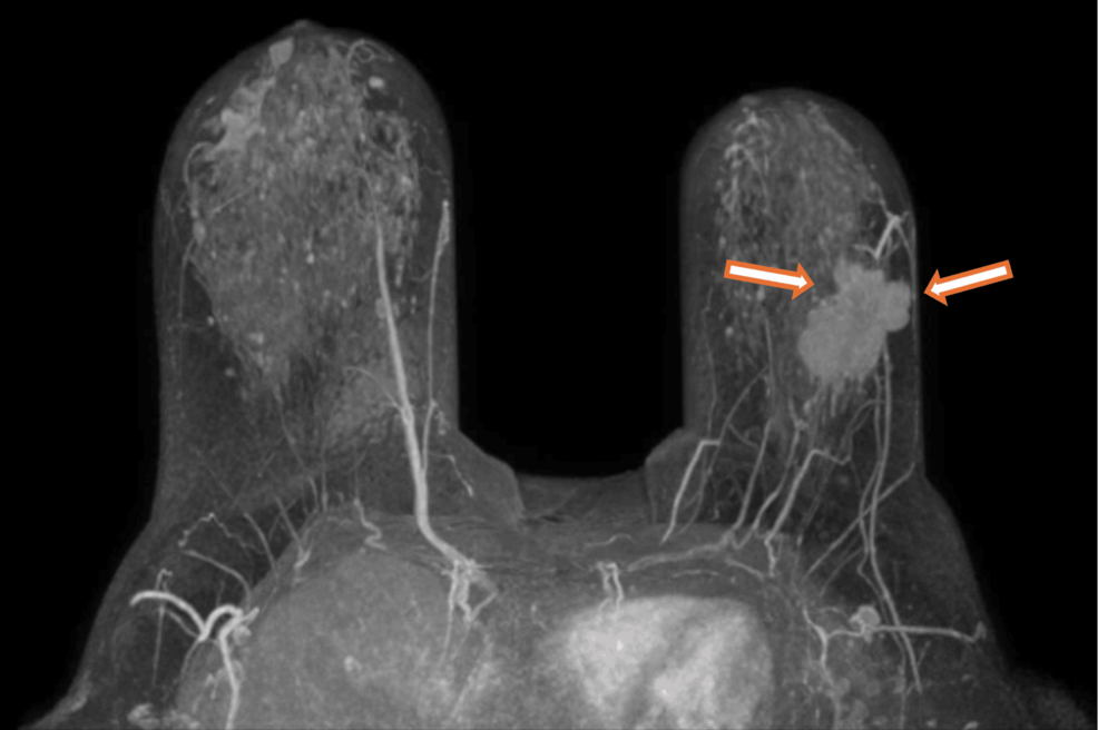 Therapeutic Challenges in the Use of Chemotherapy and Cyclin-Dependent Kinase 4/6 Inhibitors in a Patient With Charcot-Marie-Tooth Disease and Breast Cancer