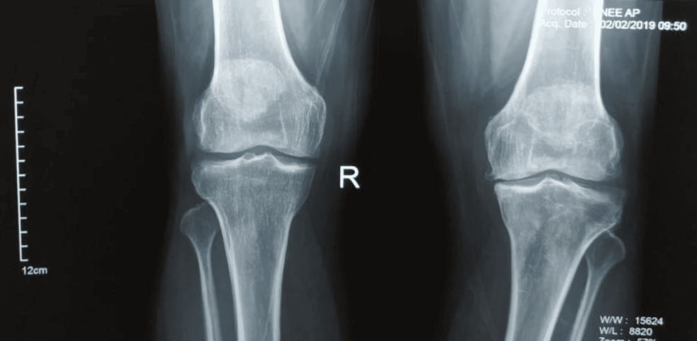 Proximal Fibular Osteotomy in the Management of Medial Compartment Osteoarthritis of the Knee: A Prospective Study