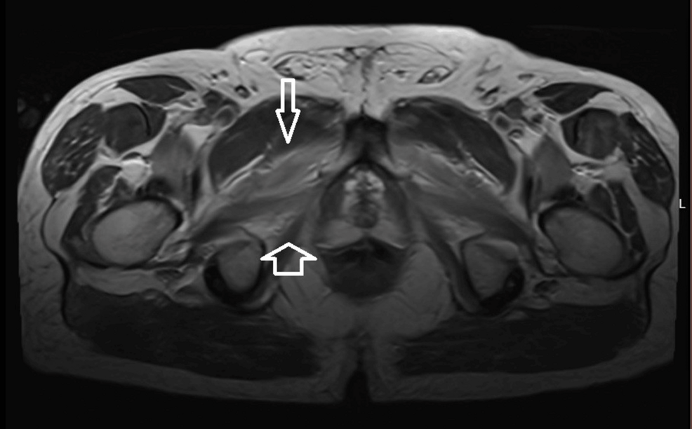 Statin-Associated Necrotizing Autoimmune Myopathy: Unmasking 3-Hydroxy-3-Methylglutaryl-CoA Reductase (HMGCR) Antibody-Positive Disease After Statin Re-exposure