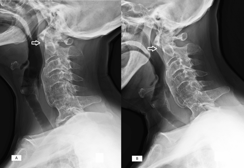 Management of C1-C2 Myelopathy Due to Periodontoid Pseudotumor With a Successful Posterior Stabilization and Decompression: A Case Report