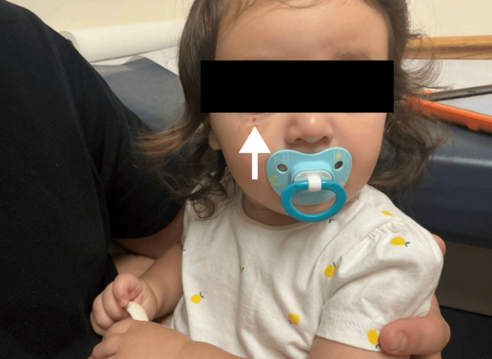 Profuse Bleeding From a Pyogenic Granuloma As the First Clue to von Willebrand Disease in a Pediatric Patient