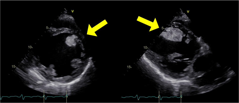 The Emergency Resection of a Mobile Left Ventricular Thrombus in Dilated Cardiomyopathy: A Case of Multiorgan Embolism and Postoperative Ventricular Tachycardia