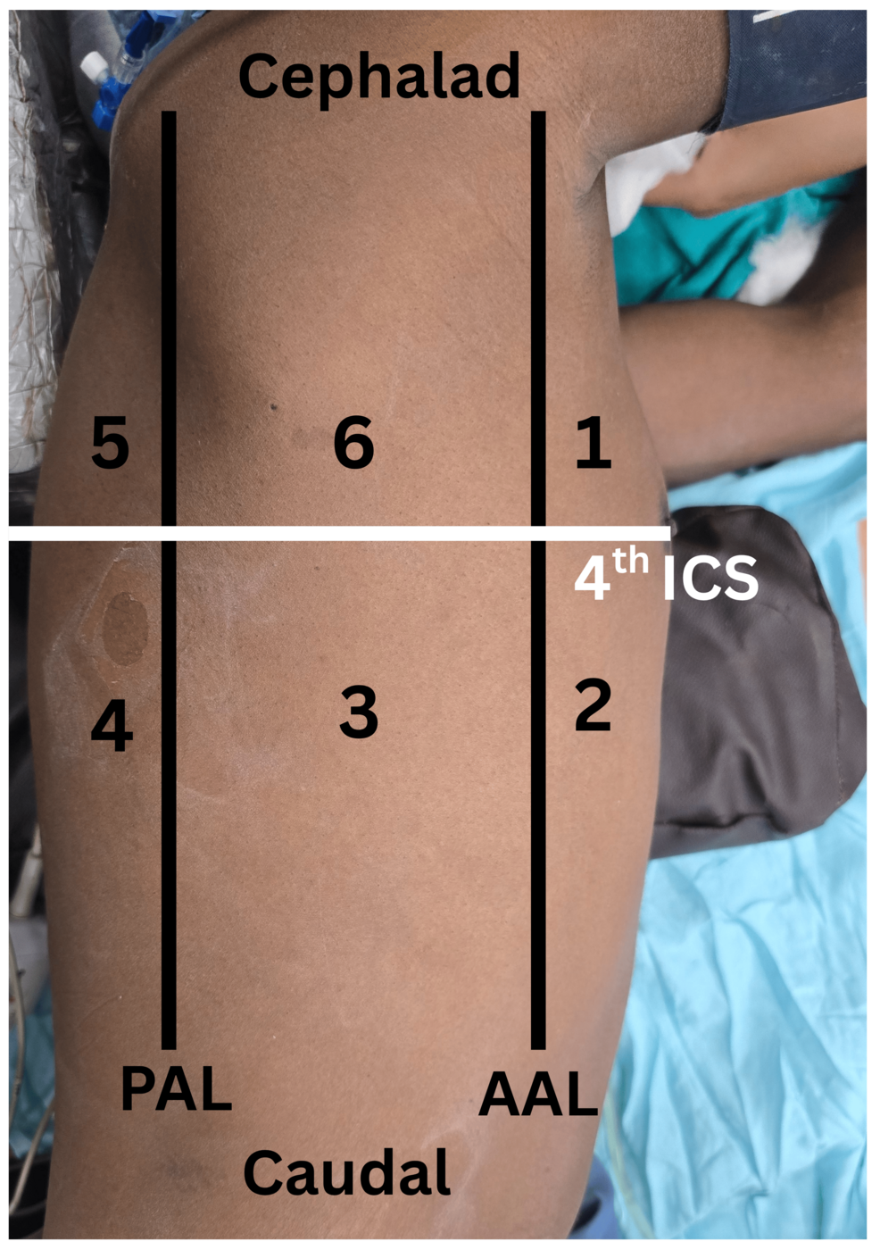 Effect of High-Flow Nasal Oxygen Versus Conventional Oxygen Therapy on Postoperative Atelectasis in Obese Cardiac Surgical Patients: Randomized Controlled Trial