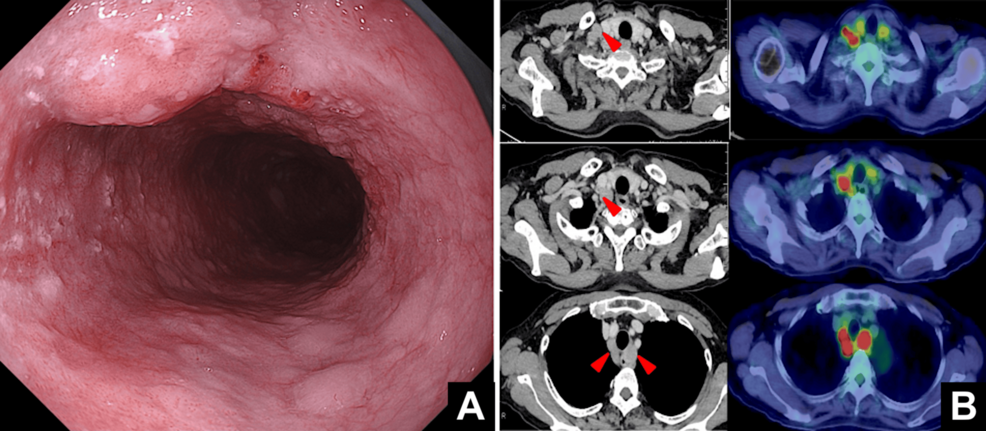 Drug Reaction With Eosinophilia and Systemic Symptoms (DRESS) Following Conversion Surgery for Esophageal Cancer: A Case Report