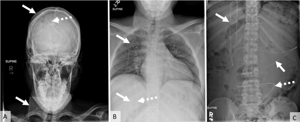 Ventriculoperitoneal Shunt-Associated Cerebrospinal Fluid Pseudocyst Presenting as Abdominal Distension and Pain in an Adult Female Patient: A Case Report