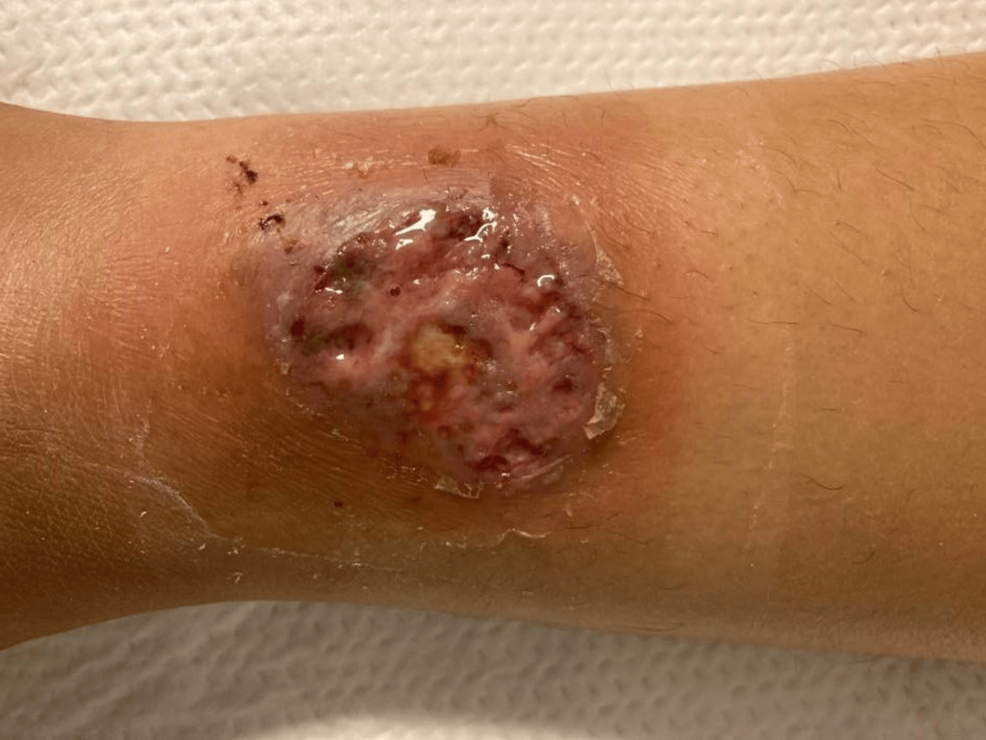 Pyoderma Gangrenosum as a Presenting Symptom of Inflammatory Bowel Disease