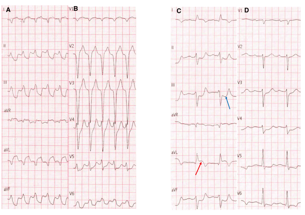 Ventricular Tachycardia as a Manifestation of Cardiac Metastasis Mimicking Acute Coronary Syndrome: A Case Report