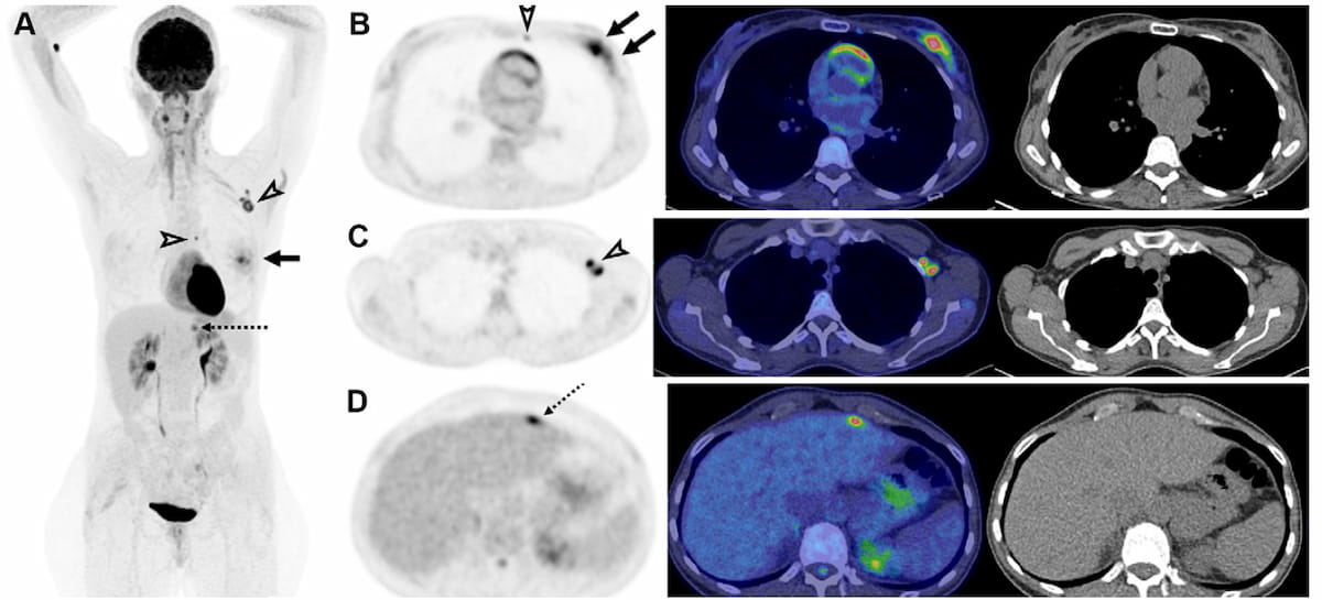 Study Suggests Benefits of FDG PET/CT for Detecting Oligometastatic Breast Cancer