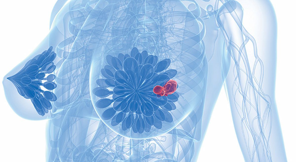 DCISionRT Shows Superiority vs Clinicopathology in Predicting DCIS Risk