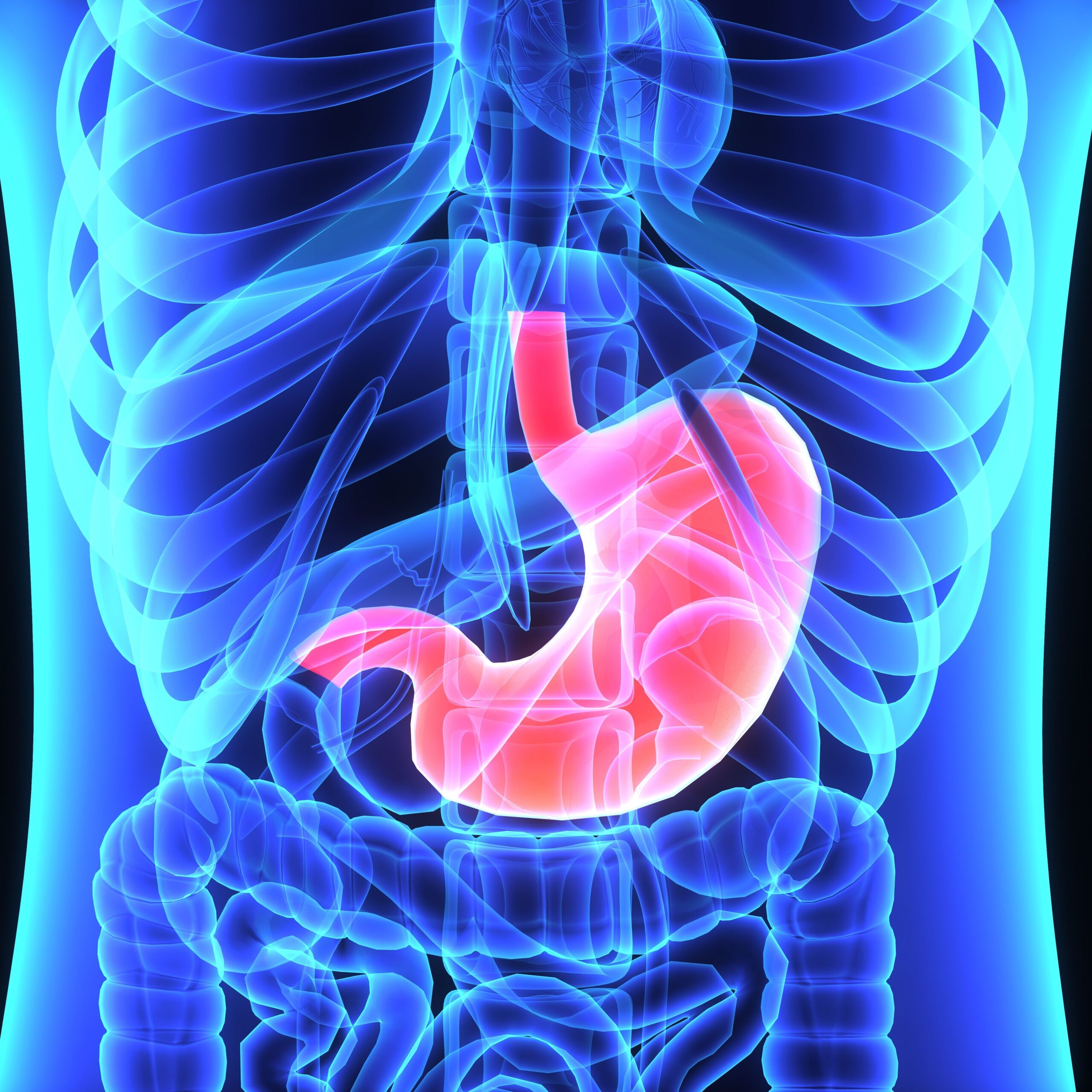 Chemoradiation Shows Long-Term Clinical Benefit in High-Risk Gastric Cancer