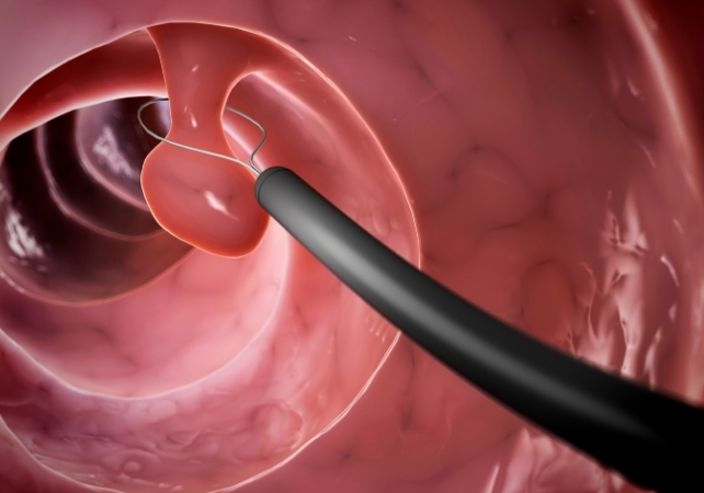 bowel polyp