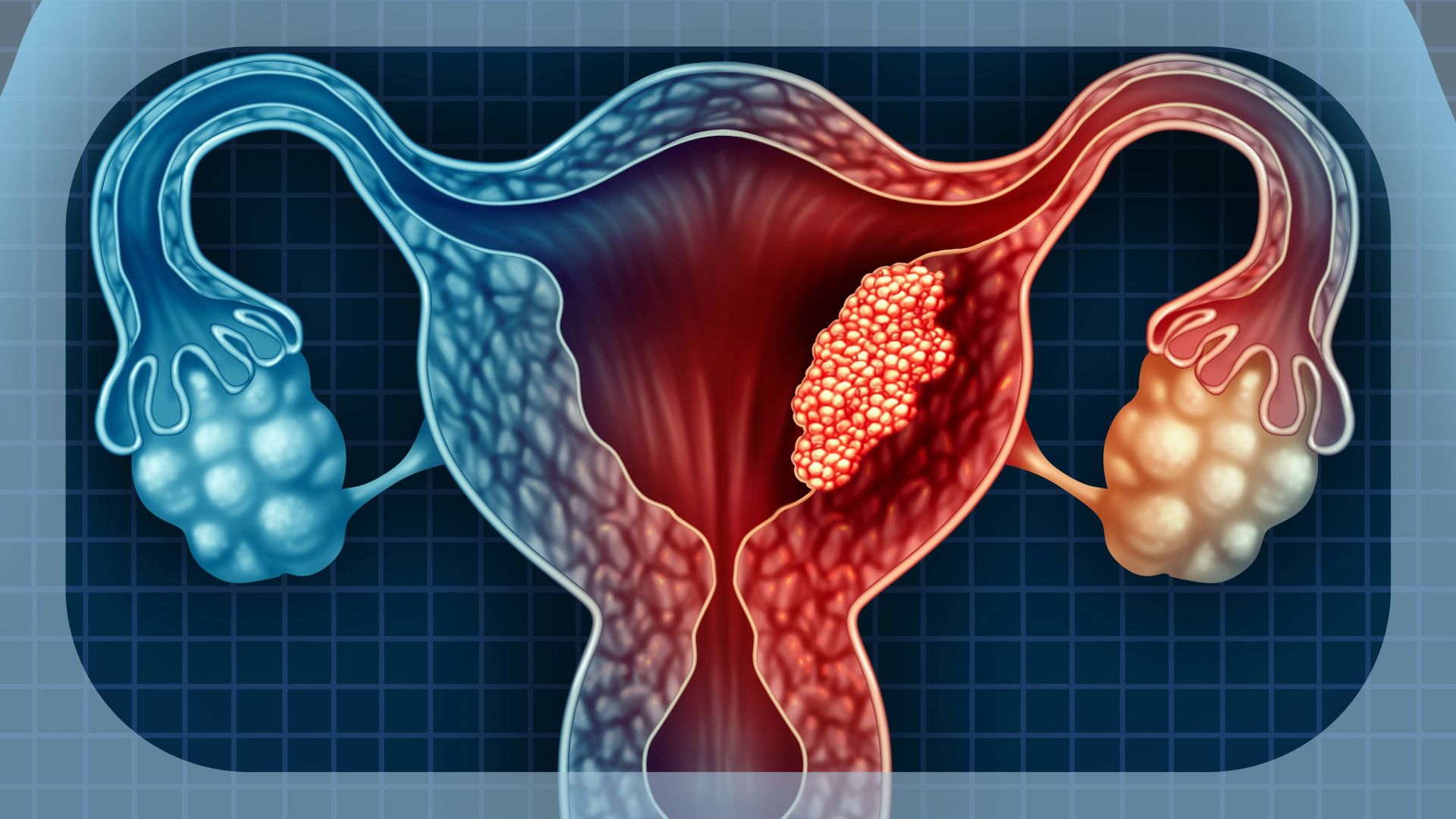 Sintilimab Plus Anlotinib Shows Durability in PD-L1+ Recurrent/Metastatic Cervical Cancer