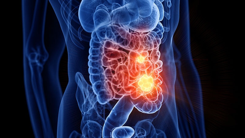 New KPIs May Cut Post-Endoscopy GI Cancer Risk