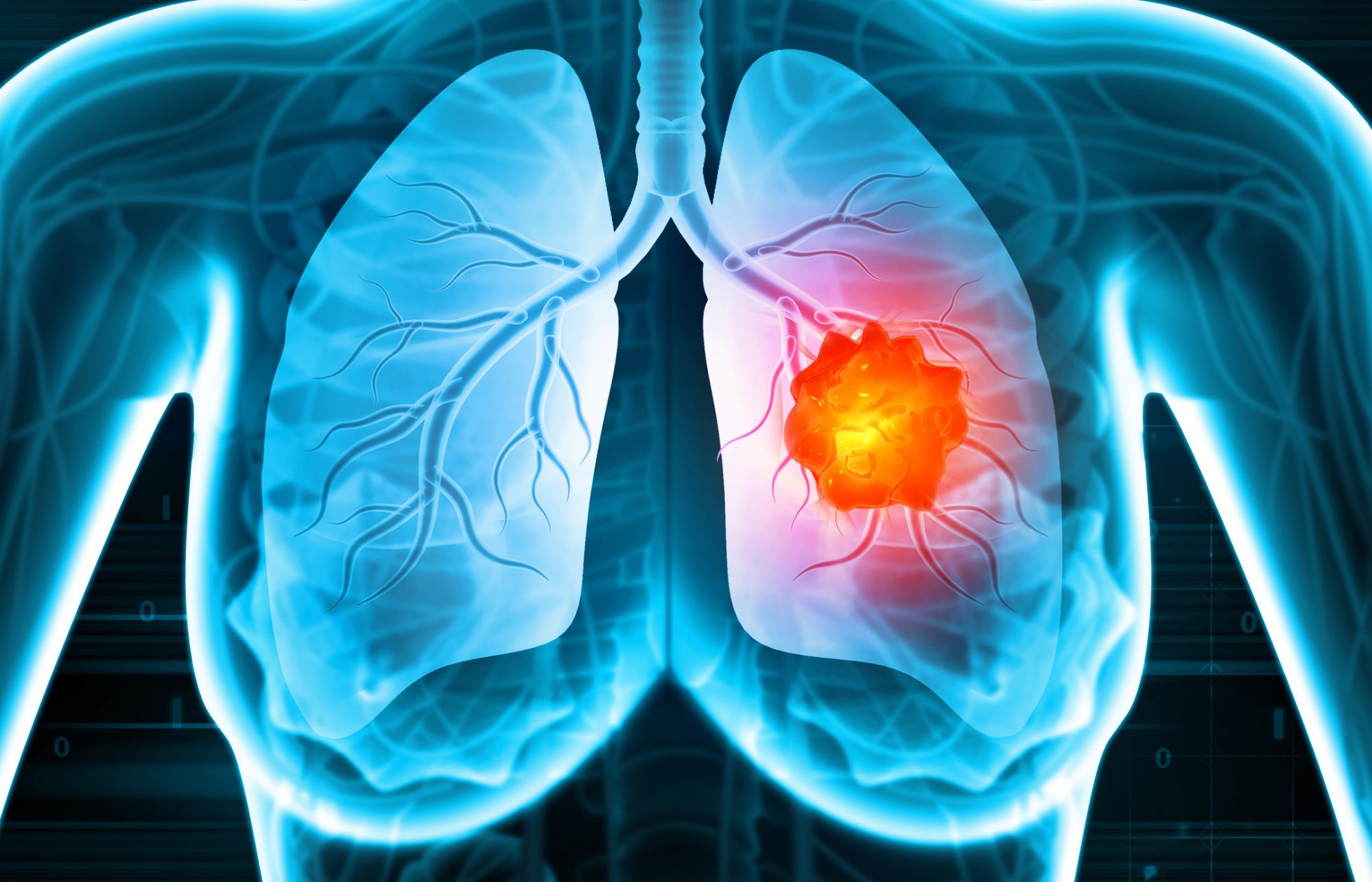 Mitochondrial transfer enhances immune cell function in lung cancer treatment