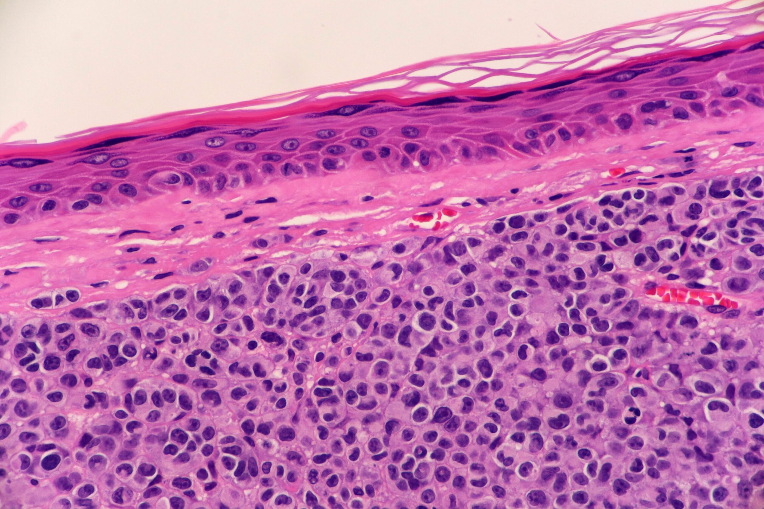 Treatment-Resistant Melanoma Novel Checkpoint Inhibitor Combination