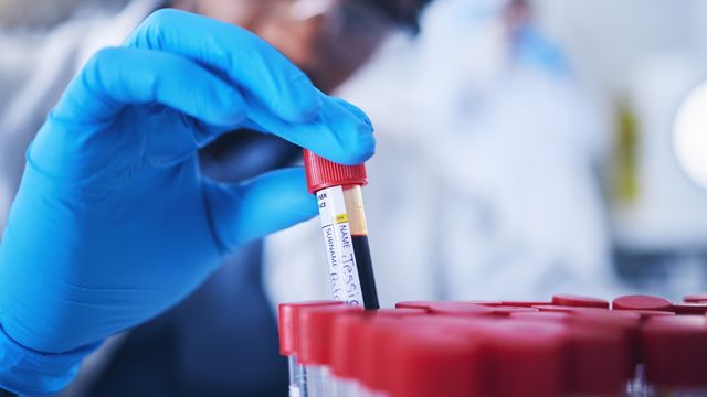 Scientists Develop Blood Test for Multiple Myeloma
