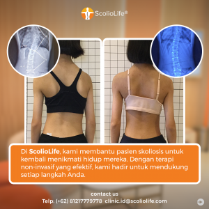 ScolioLife Scoliosis Results