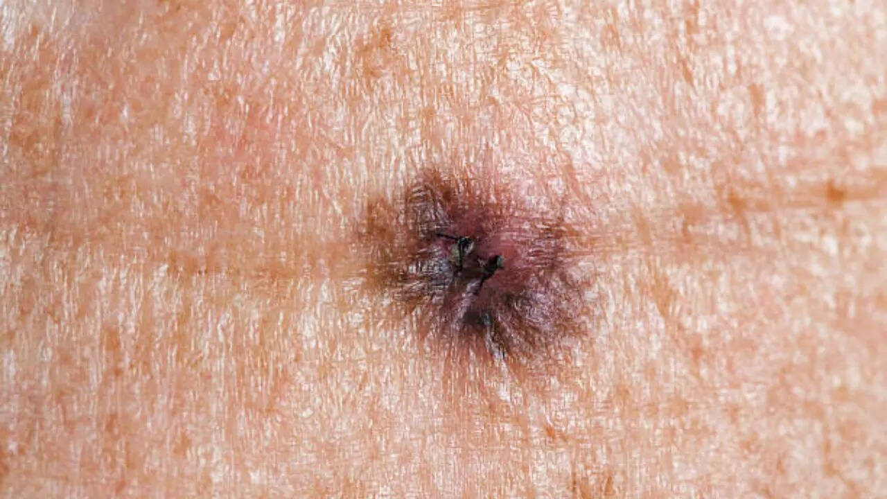 Image credits: Getty Images Types of skin cancer