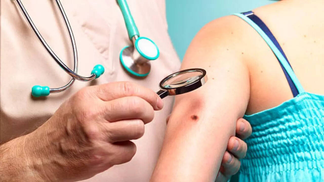 Image credits: Getty Images What are the signs of skin cancer?