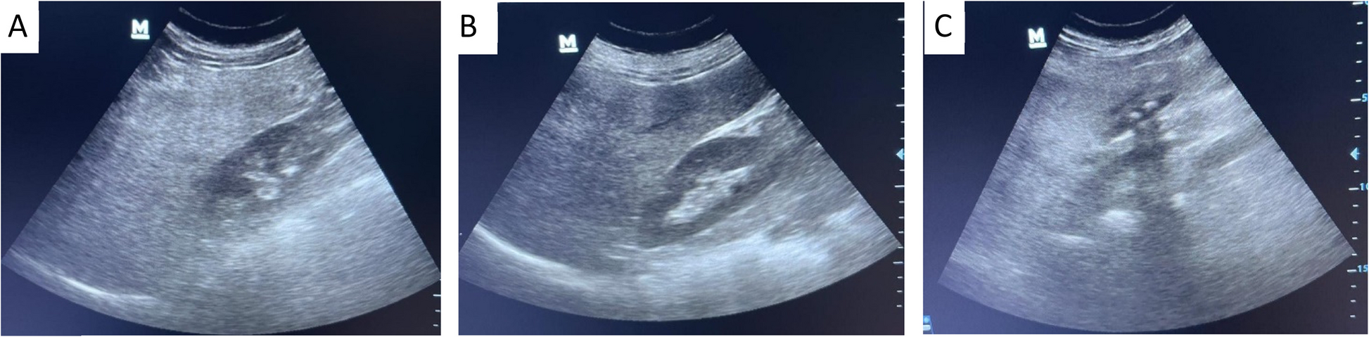 Screening for metabolic-associated fatty liver disease in type 2 diabetes patients using non-invasive scores and ultrasound: a cross-sectional study in Egypt | BMC Gastroenterology