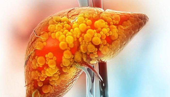 Scientists discover key cause of liver disease, promising step towards new treatment