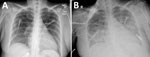 Chest radiographs from an organ donor with murine typhus, from a study describing the transmission of Rickettsia typhi from an organ donor to 2 kidney transplant recipients, Texas, 2024. A) Chest radiograph obtained at hospital admission, 5 days after symptom onset, with no specific abnormalities noted. B) Chest radiograph obtained on hospital day 3, revealing extensive alveolar opacities predominantly in the middle and lower lung fields.