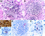 Histopathological and immunohistochemical features of formalin-fixed, paraffin-embedded biopsy specimens collected from the right and left kidney allografts procured from a donor who died of murine typhus, from a study describing the transmission of Rickettsia typhi from an organ donor to 2 kidney transplant recipients, Texas, 2024. A) When stained with hematoxylin and eosin, both allografts showed multifocal, interstitial, and predominantly mononuclear peritubular infiltrates, associated with focal endarteritis (thin arrows), features of acute tubular injury, including epithelial attenuation with loss of apical cytoplasm (thin arrowheads), and pigmented casts (large arrow). B) Glomeruli displayed moderate mesangial hypercellularity and tuft adhesions to the Bowman’s capsules (arrows) and intracapillary and mesangial phagocytic foam-cells (arrowheads), That finding is compatible with focal segmental glomerulosclerosis. C) Short chains comprising small, rod-shaped bacteria were revealed in glomerular capillaries by the Warthin–Starry silver impregnation staining technique. Immunoreactive R. typhi antigens were noted within intracellular bacteria in endothelial cells of renal arterioles. D–F) An immunohistochemical stain for typhus-group rickettsiae revealed intact bacteria within endothelial cells of inflamed small vessels and vascular spaces of mesangial capillaries (arrows) and phagocytized bacterial antigens in the cytoplasm of glomerular foam-cells (arrows). Original magnifications ×400 (A, B and E) and ×1,000 (C, D, and F).