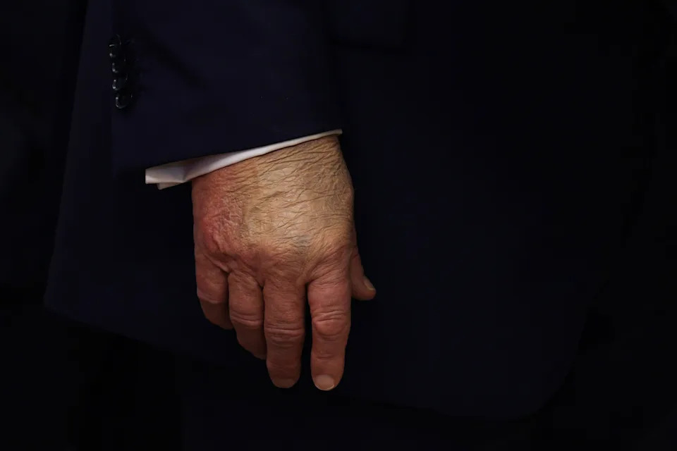 A detailed view of President Trump's right hand in the Oval Office on Tuesday. (Alex Wong/Getty Images)