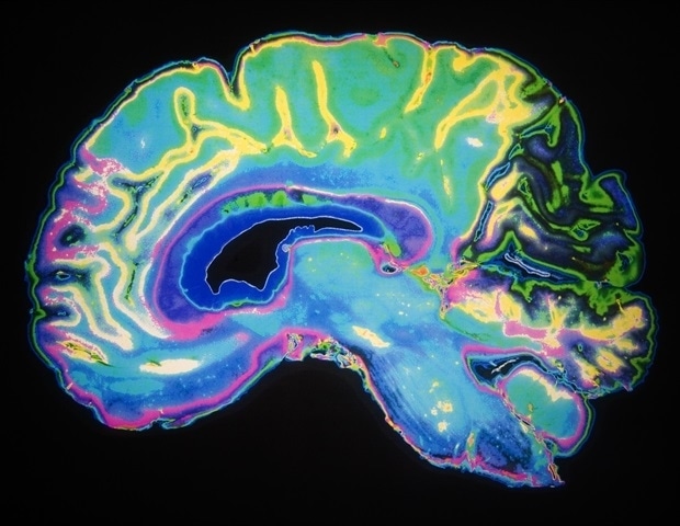 Special MRI technique predicts onset of mild cognitive impairment and cognitive decline