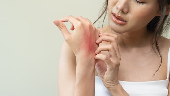 People with dry skin are likely to be more vulnerable to eczema. ( Shutterstock)