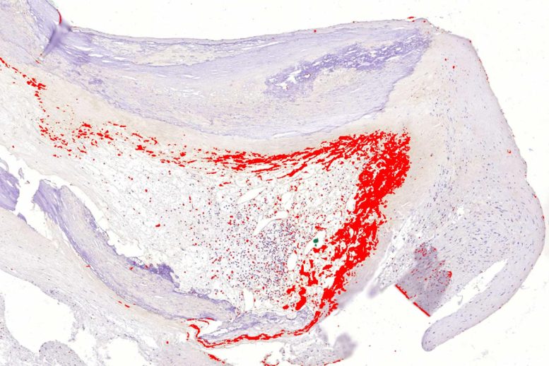 Bacterial Biofilm Lining Coronary Artery Plaque