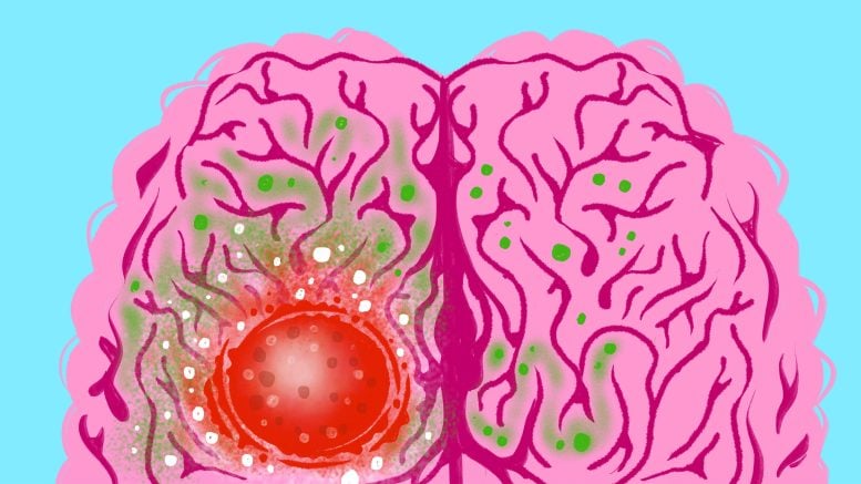 Brain Cells Sugar Glioblastomas Graphic