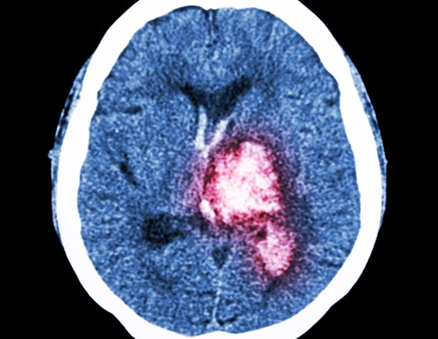 Targeting complement with an inhibitor may prevent preterm birth and protect the baby’s brain