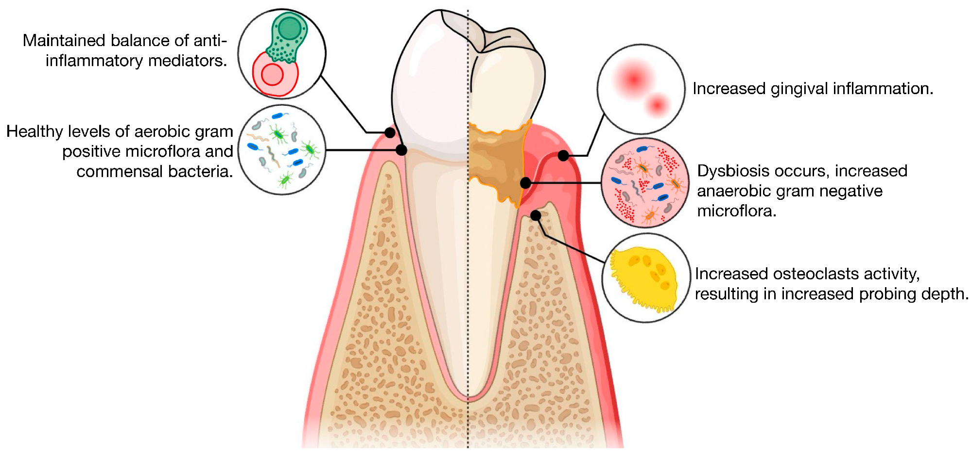 Illustration of the pathogenesis of periodontitis, comparing health with periodontitis.