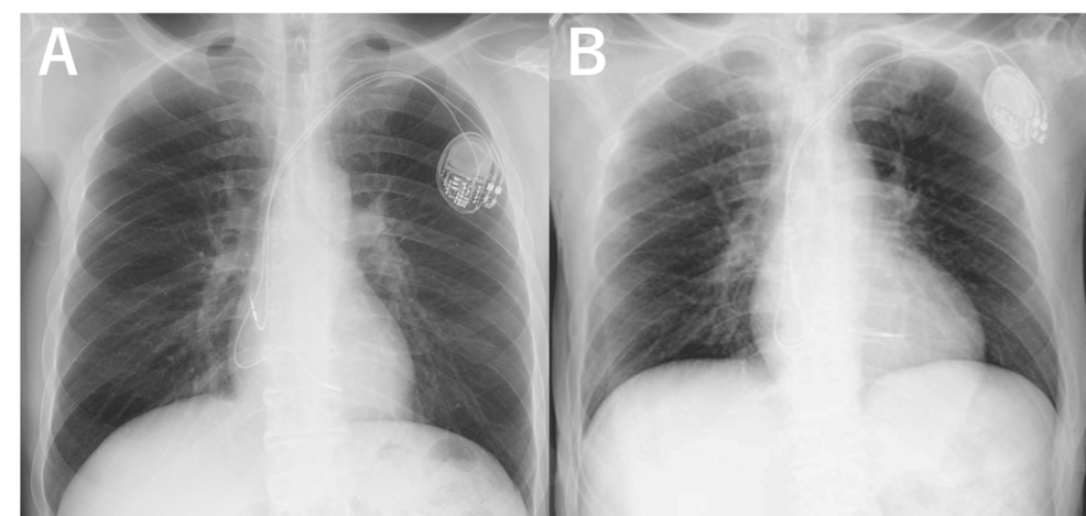A Case of Delayed Right Ventricular Pacemaker Lead-Associated Perforation Causing Cardiac Tamponade