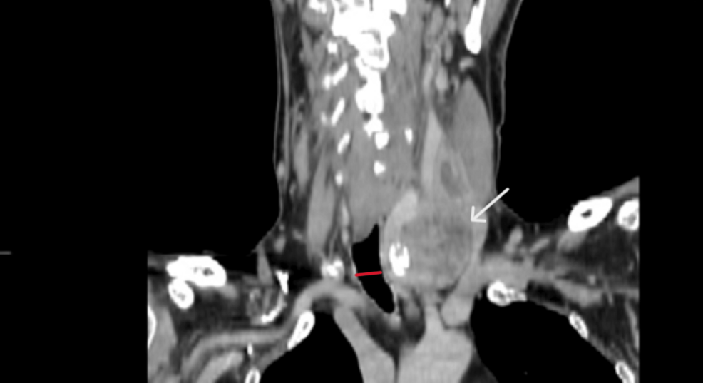 Thyroid Cancer Surgery in a Patient With Frontotemporal Dementia: Balancing Oncologic and Neurocognitive Challenges