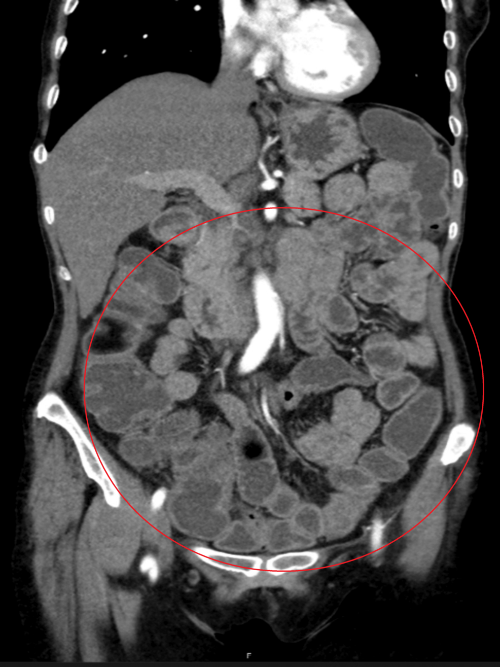 Tracking the Path of Migratory Pain: Unveiling Whipple Disease