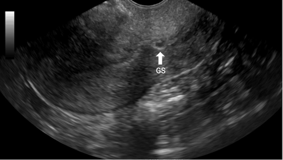 Successful Management of Cesarean Scar Ectopic Pregnancy Using Local Methotrexate Injection and Balloon Catheter Compression: A Case Report